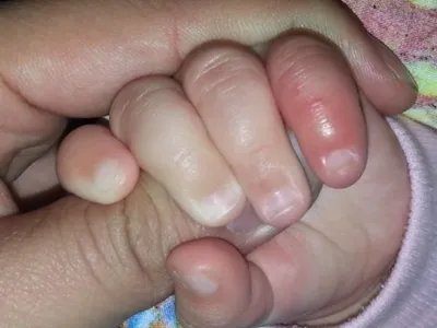 蝎蜇伤症状图片