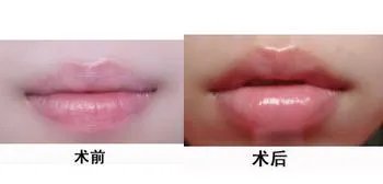 玻尿酸丰唇效果好不好