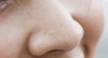 鼻孔整形哪家医院做得好