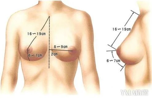 隆胸殒命手术台假体隆胸后遗症风险知多少