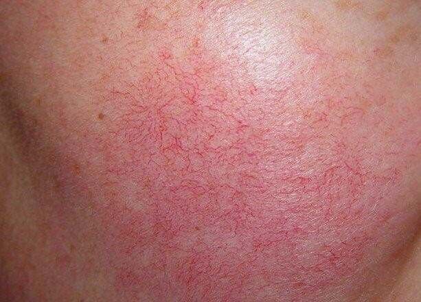 关于红血丝的症状介绍