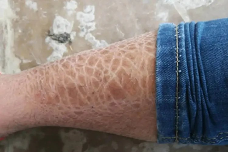 鱼鳞病小腿结痂图片