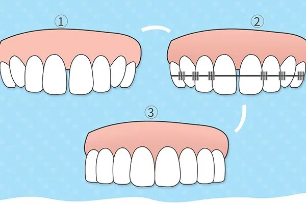 门牙有缝怎么治