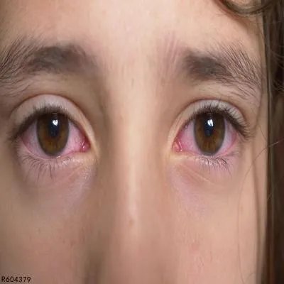 快速消除眼睛红血丝的方法有哪些