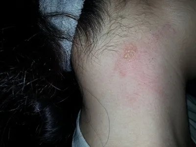 蝎蜇伤症状图片