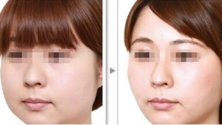 抽脂和溶脂哪个好