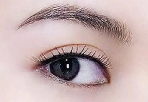 单眼皮怎样变双眼皮