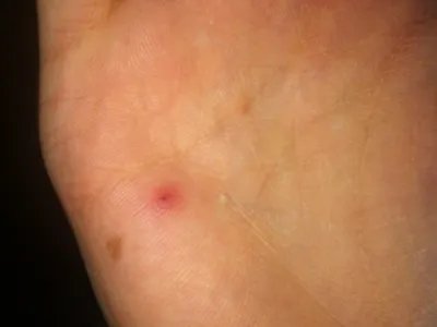 蝎蜇伤症状图片