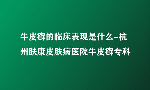牛皮癣的临床表现是什么-杭州肤康皮肤病医院牛皮癣专科