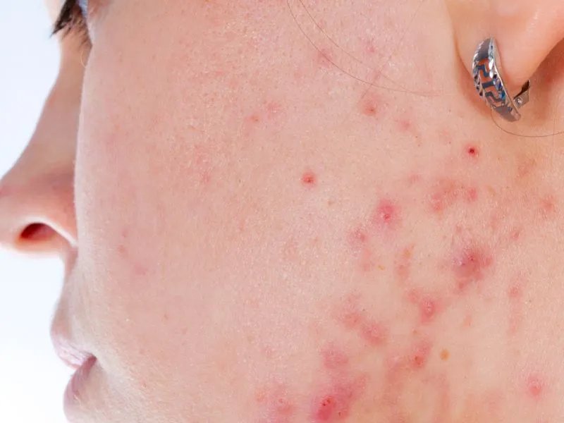 怎样消除红肿的痘痘