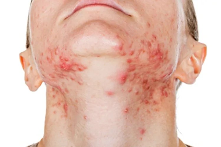 战壕热下巴症状图片