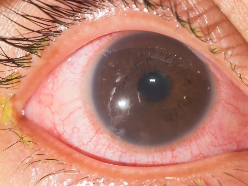 瞳孔放大的各种原因