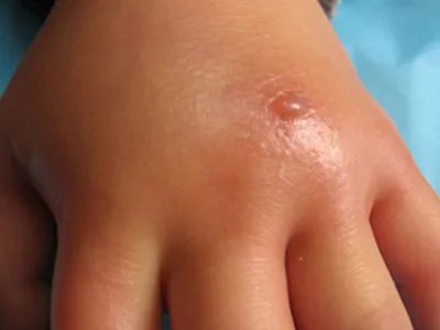 蝎蜇伤症状图片