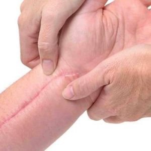 祛疤痕手术多少钱