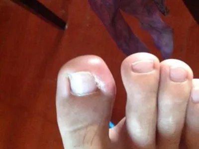 蝎蜇伤症状图片