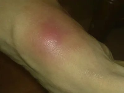 蝎蜇伤症状图片