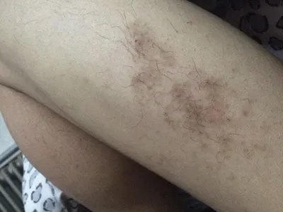 蝎蜇伤症状图片