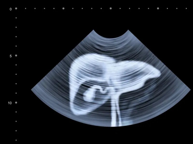 中度脂肪肝食疗