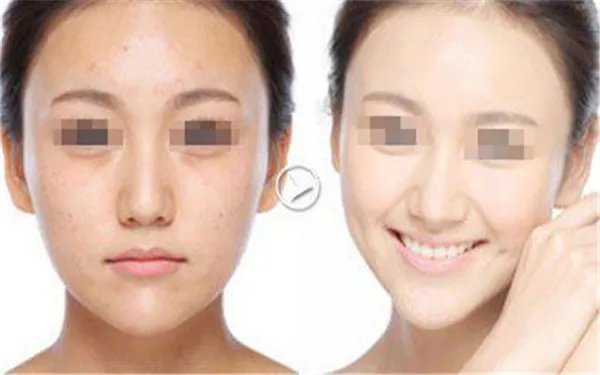 e光祛斑大概费用多少钱