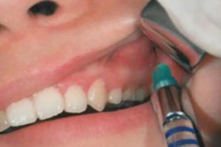 拔牙打麻药位置图解