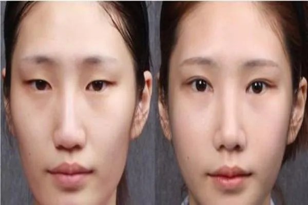 开眼角手术一般需要多少钱