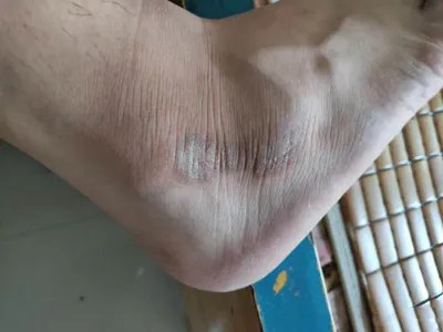 蝎蜇伤症状图片