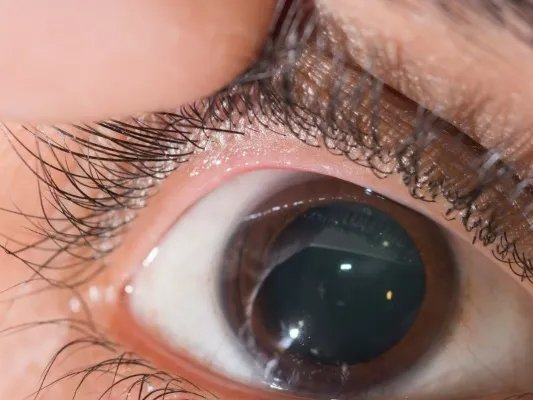 眼睛皮肤松弛怎么办