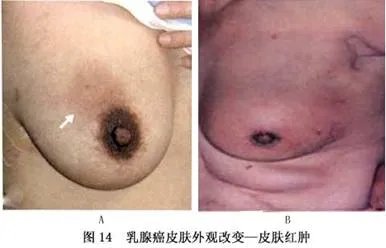 乳腺癌的早期症状图片大全