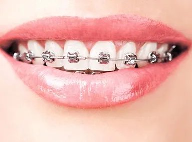 牙齿矫正价格表是什么样的呢