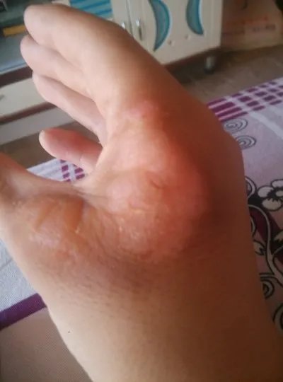 手部湿疹症状如何治疗方法?