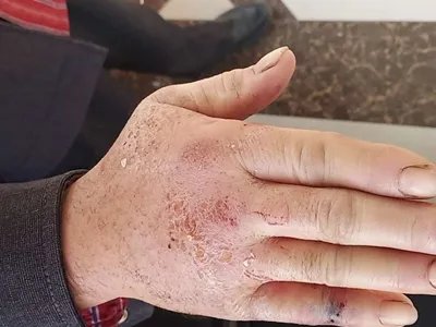 蝎蜇伤症状图片