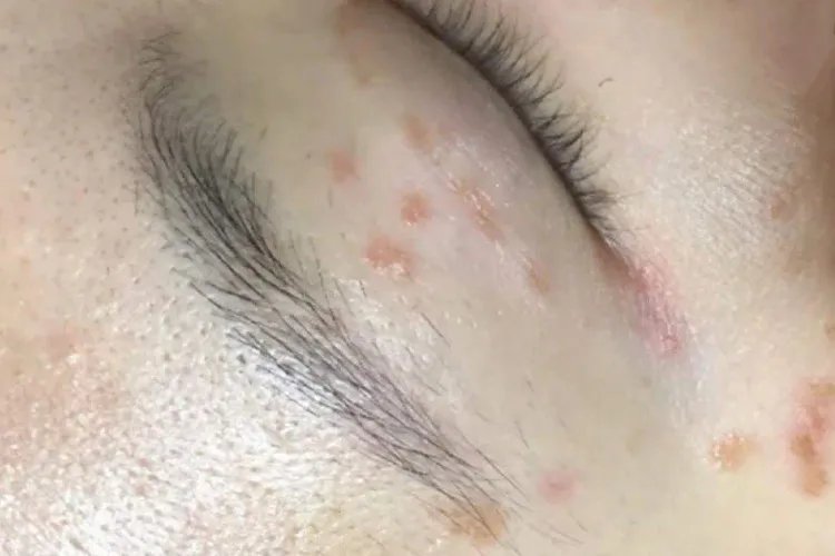 眉毛里长的疣图片