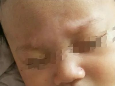 家族性进行性色素沉着症前额斑图片