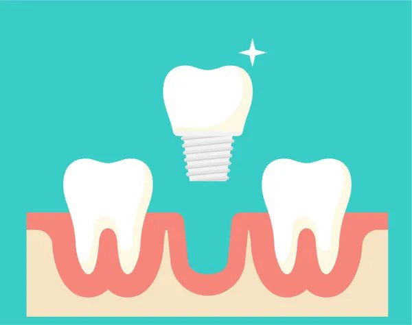换一颗种植牙需要多少费用