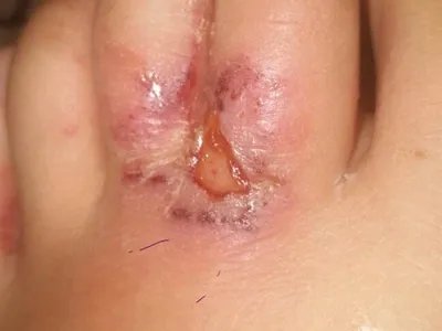 蝎蜇伤症状图片