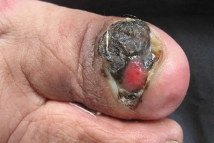 肢端雀斑样痣型黑色素瘤症状图片