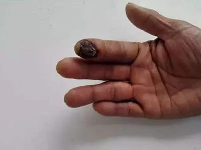 蝎蜇伤症状图片