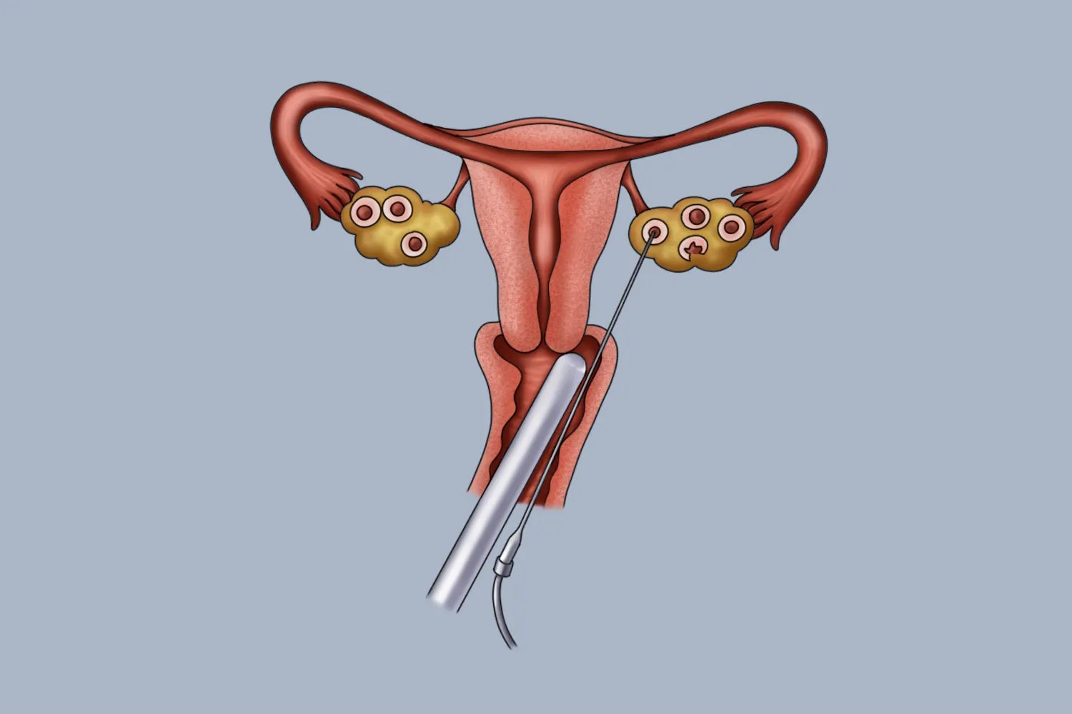 取卵针会刺穿什么部位