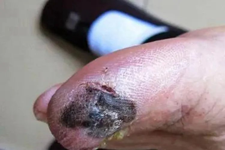 肢端雀斑样痣型黑色素瘤症状图片