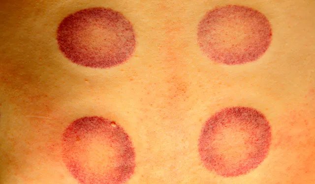 菲尔普斯热衷的拔罐，对普通人有哪些帮助？