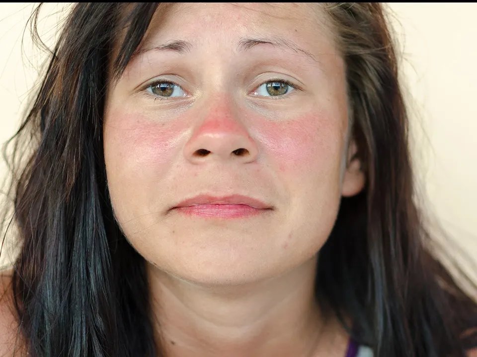 生理盐水治皮肤过敏吗? 针对皮肤过敏的其他方法有什么?