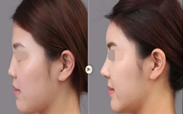 隆鼻一般要多少钱