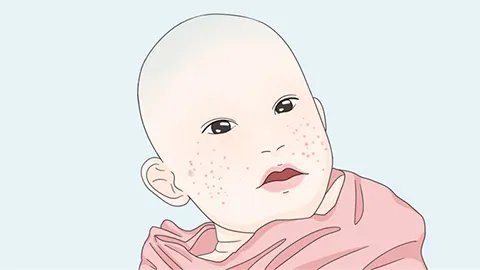 面部湿疹有什么症状