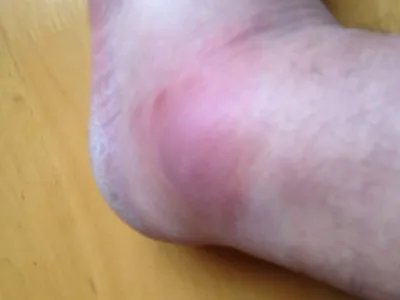 蝎蜇伤症状图片