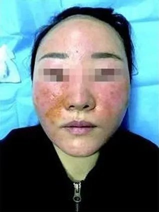 花3万美容变毁容是怎么回事？