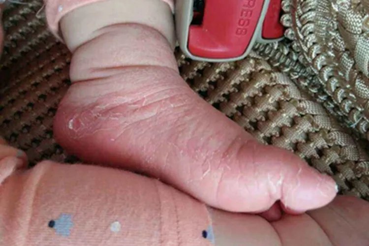 干燥型婴儿湿疹脚部脱皮图片