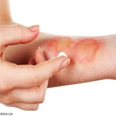 三度烫伤后怎么处理