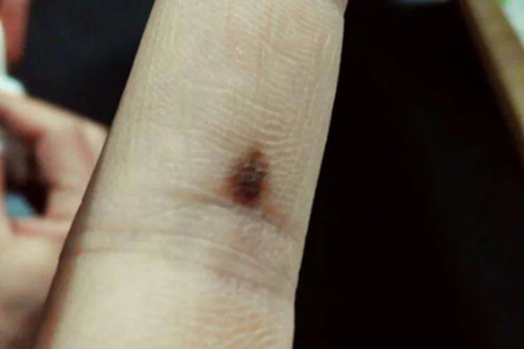 肢端雀斑痣样黑素瘤症状图片