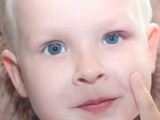 治疗年少白发的方法