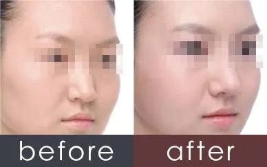 光子嫩肤的价格是多少